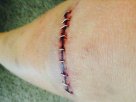Brixeys Frankenknee.jpg